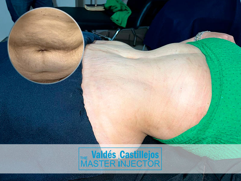 Servicios-Valdes-Castillejos-LIPOABDOMINOPLASTIA