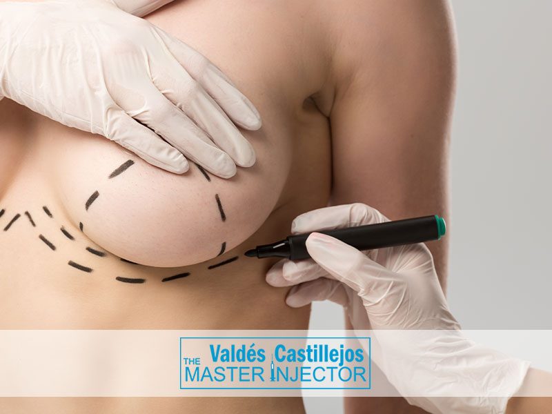 Servicios-Valdes-Castillejos-MASTOPEXIA-SIN-IMPLANTES