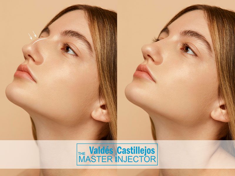 Servicios-Valdes-Castillejos-RINOPLASTIA